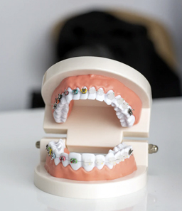 Dental Braces