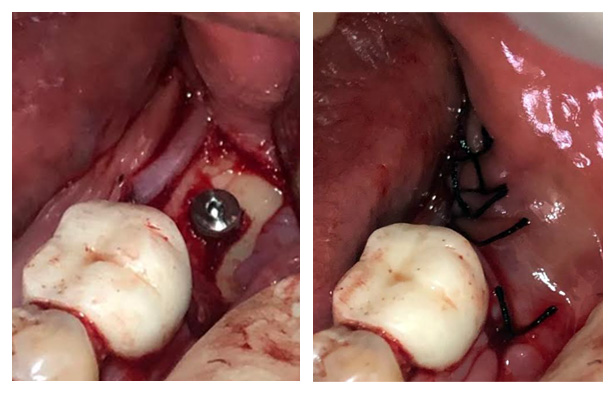 Implant Placement