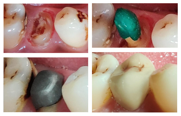 Pre/Post Metal Case Trial